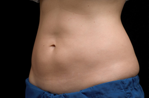 After CoolSculpting