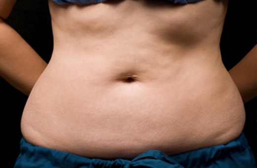 After CoolSculpting