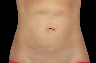 After CoolSculpting