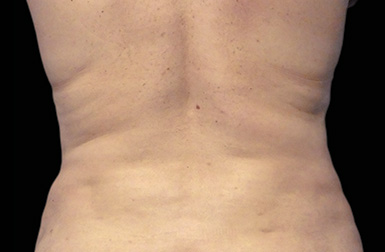 CoolSculpting After