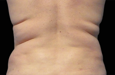 CoolSculpting before