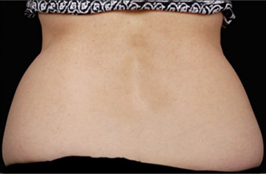 CoolSculpting before