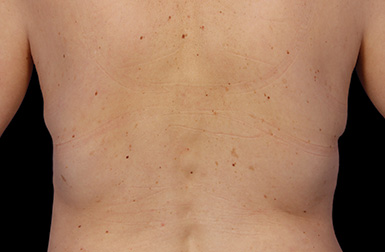 CoolSculpting_Flank_after