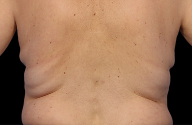 CoolSculpting_Flank_before