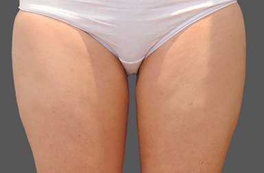 CoolSculpting After