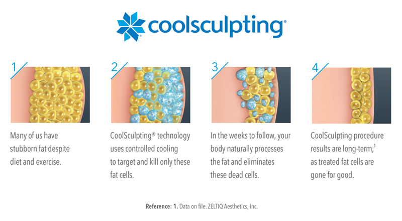 Coolsculpting-animated-image-horizontal